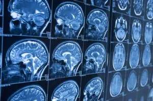 How Catania and Catania Injury Lawyers, Can Help If You’ve Suffered a Brain Injury in Tampa